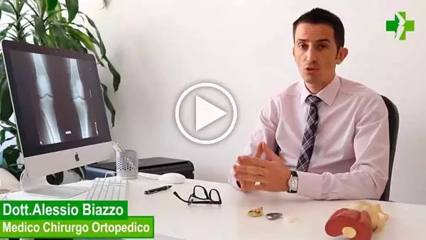 Protesi monocompartimentale ginocchio video di presentazione del Dott Alessio Biazzo