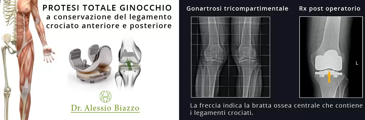 protesi totale ginocchio mininvasiva a conservazione dei legamenti crociati - Dott Alessio Biazzo