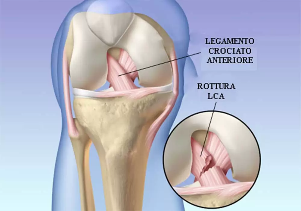  Il legamento crociato anteriore rappresenta, insieme al legamento crociato posteriore, il principale stabilizzatore del ginocchio