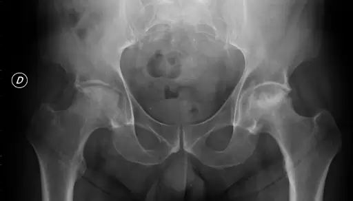 Osteonecrosi dell'anca - Radiografia