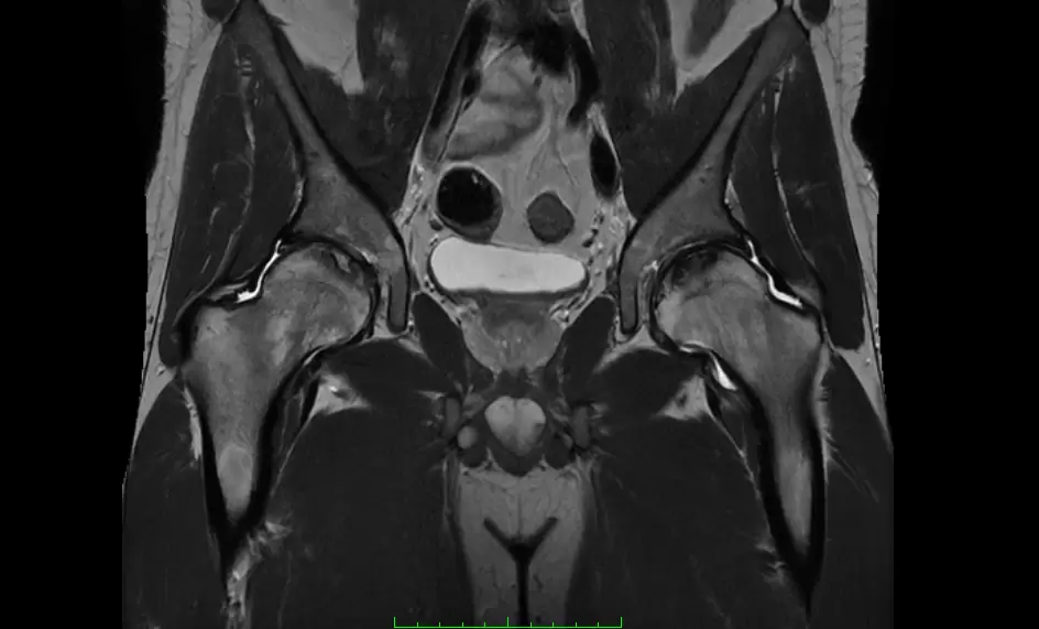 Osteonecrosi dell'anca - Risonanza magnetica